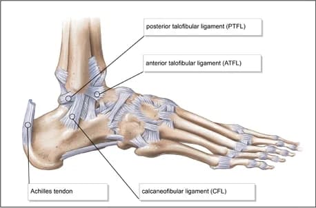 ATFL Tear Injury