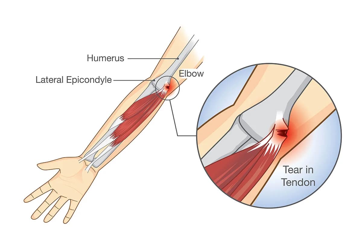 Golfer's Elbow Treatment