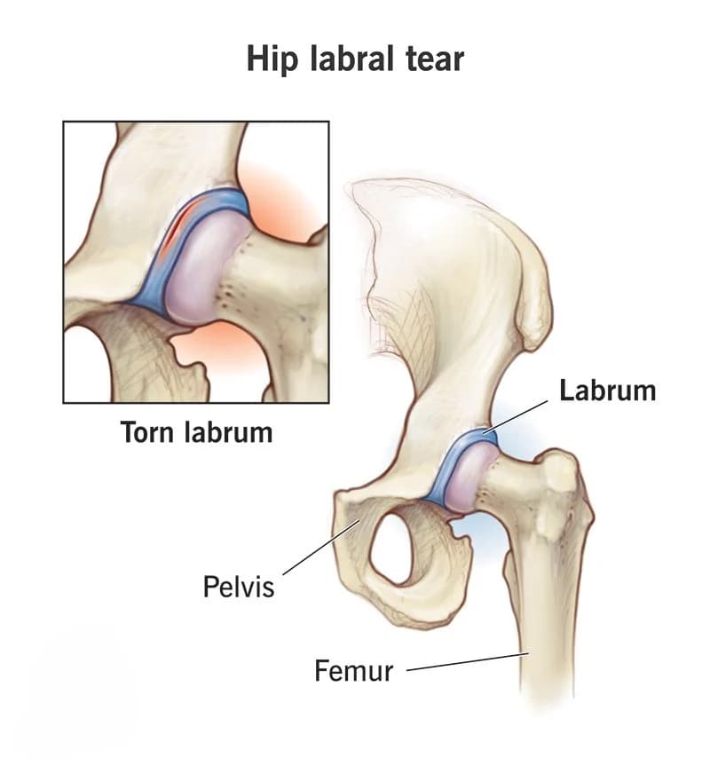 Hip Labral Tear Treatment