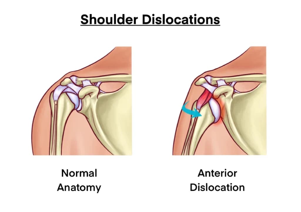 Recurrent Shoulder Dislocation Treatment