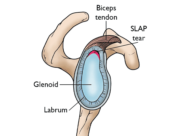 SLAP Tear Procedure