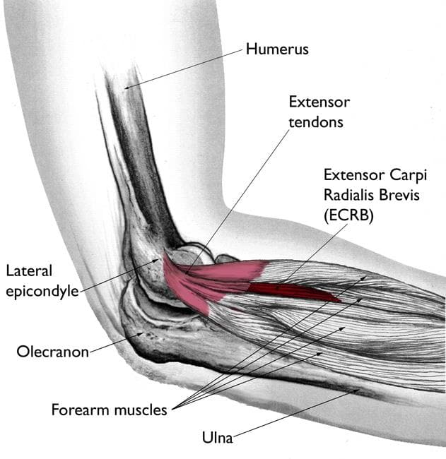 Tennis Elbow Treatment