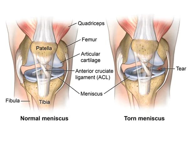 Meniscus Injury Procedure